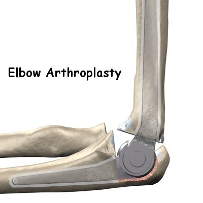 Elbow Replacement Surgery in Nagpur