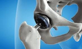 Hip Replacement Surgeon in Nagpur